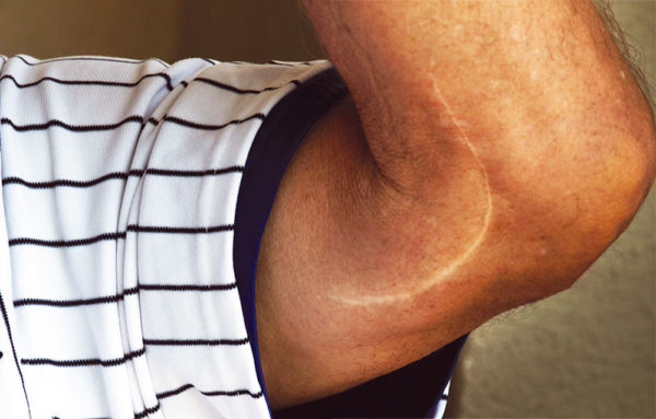 The truth about Tommy John surgery - New England Baseball Journal